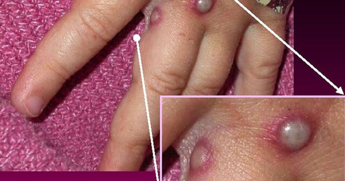 وزارت بهداشت: وضعیت «آبله میمون» در دنیا/ هنوز مورد مشکوک در ایران نداشتهایم وزارت بهداشت: وضعیت «آبله میمون» در دنیا/ هنوز مورد مشکوک در ایران نداشتهایم