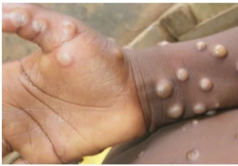 یک توصیه مهم برای مبتلایان به آبله میمونی یک توصیه مهم برای مبتلایان به آبله میمونی