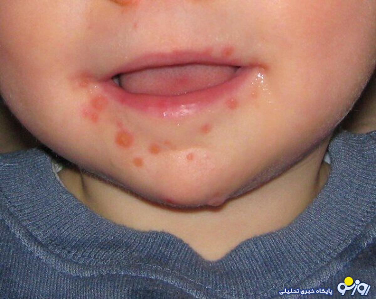 شیوع بیماری دست و پا و دهان در تهران شیوع بیماری دست و پا و دهان در تهران