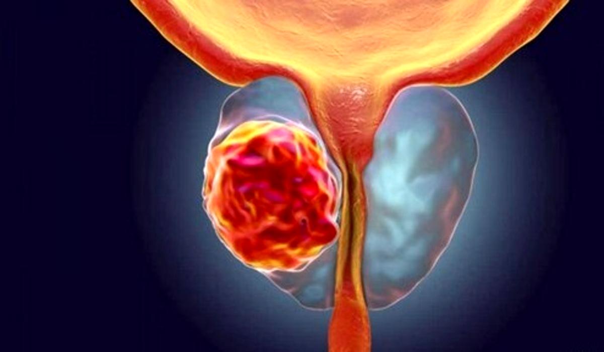 این دو سرطان بلای جان مردان! این دو سرطان بلای جان مردان!